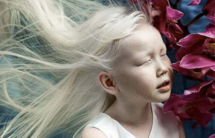 9-year-old albino girl: modeling agencies offer her contracts